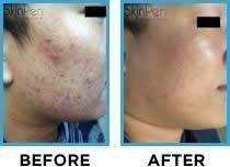 , Microneedling Before And After