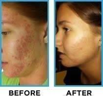 , Microneedling Before And After
