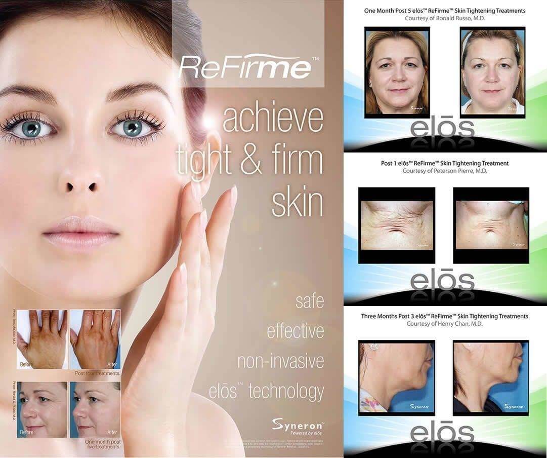 , Skin Tightening and ReFirme Photos
