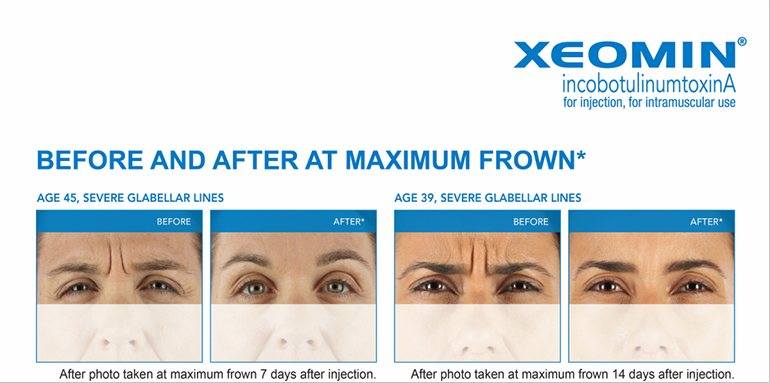 xeomin before after 1