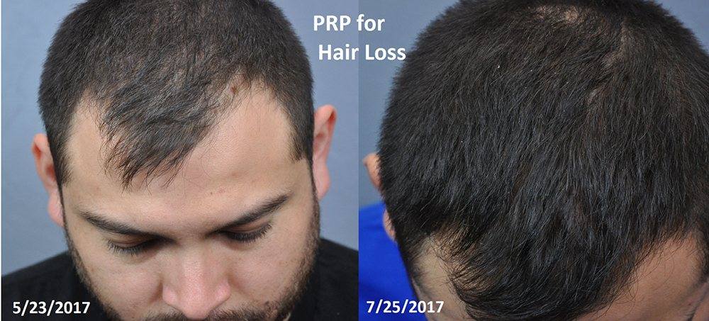 Patient 1 Before and After PRP