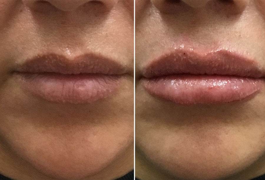, Lip Filler Before and Afters
