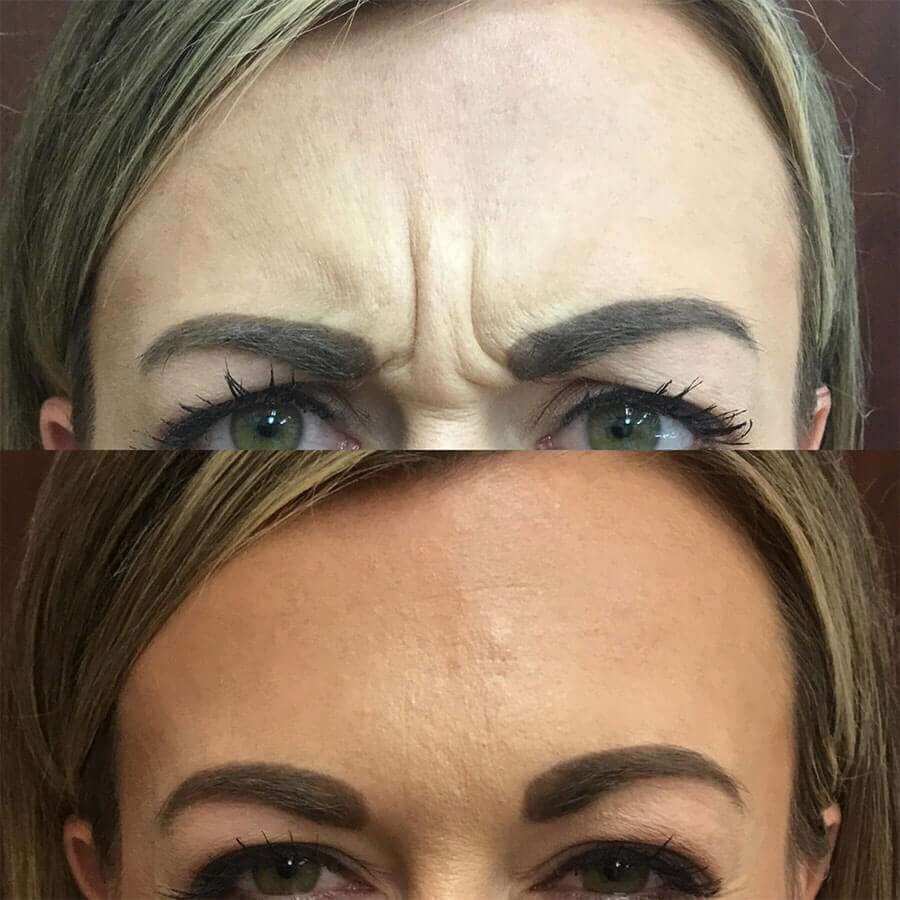 , Botox Before and Afters