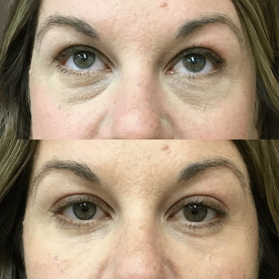, Tear Trough Fillers Before and Afters