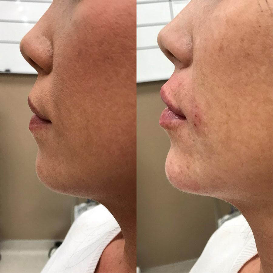 , Chin Fillers Before and Afters