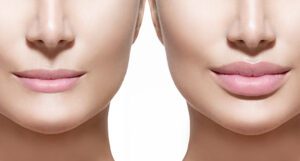 Juvederm: Understanding the Right Quantity for Your Beauty Goals | H-MD Medical Spa