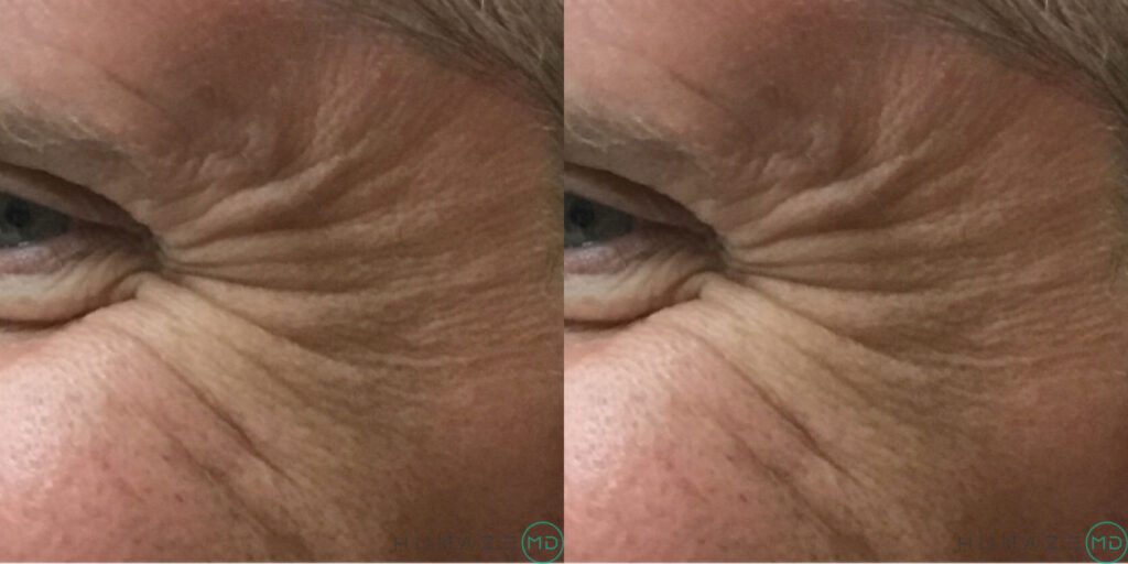 Neuromodulator Before & After Pictures | H-MD Medical Spa