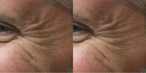 Neuromodulator Before & After Pictures | H-MD Medical Spa