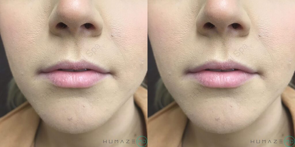Restylane Before and After Photos | H-MD Medical Spa