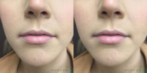 Restylane Before and After Photos | H-MD Medical Spa